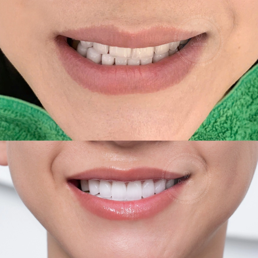 Sau khi tháo răng sứ hoàn toàn có thể bọc lại